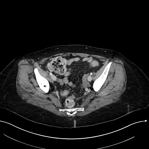 File:Closed loop small bowel obstruction - adhesions (Radiopaedia 59078-66369 A 108).jpg