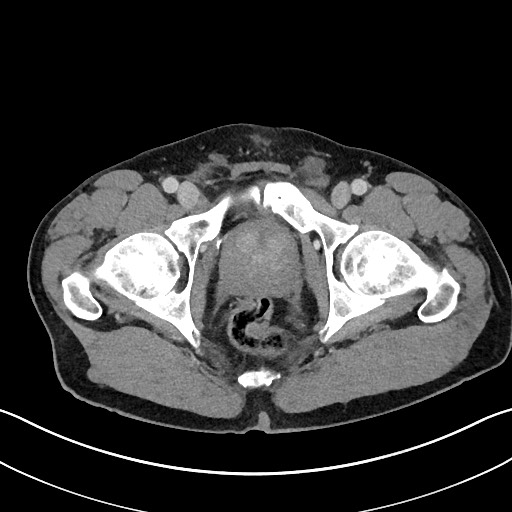 File:Closed loop small bowel obstruction - internal hernia (Radiopaedia 57806-64778 B 123).jpg
