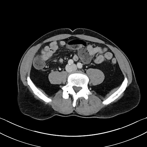 Closed loop small bowel obstruction - internal hernia (Radiopaedia 57806-64778 B 78).jpg