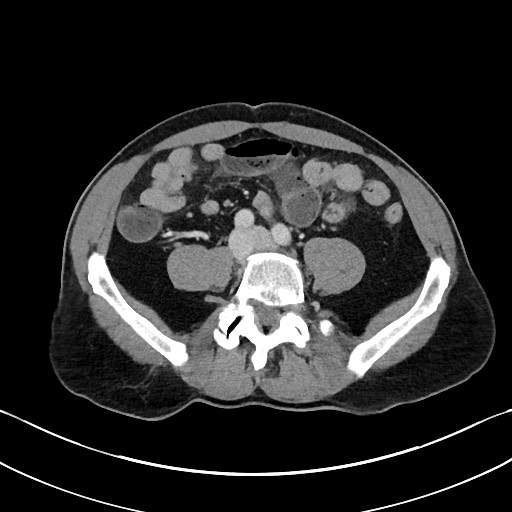 Closed loop small bowel obstruction - internal hernia (Radiopaedia 57806-64778 B 80).jpg