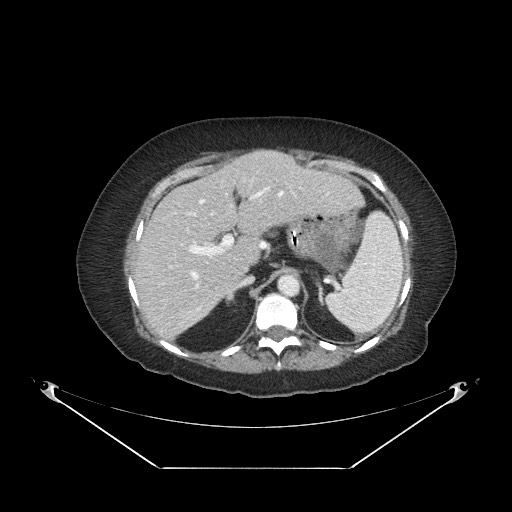 Closed loop small bowel obstruction - internal hernia (Radiopaedia 65402-74450 A 24).jpg