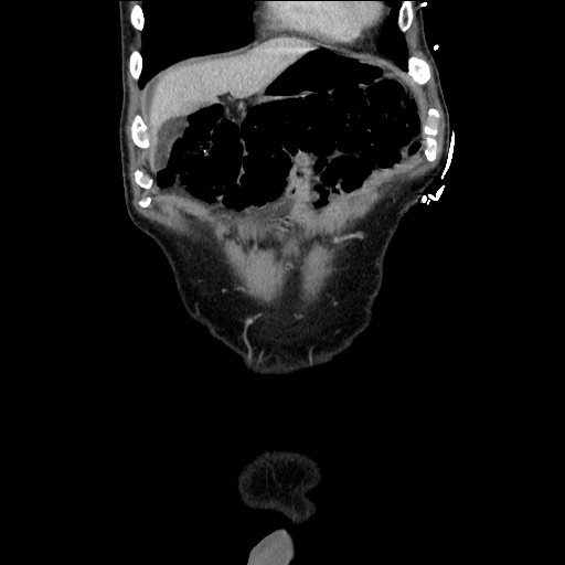 Closed loop small bowel obstruction - omental adhesion causing "internal hernia" (Radiopaedia 85129-100682 B 30).jpg