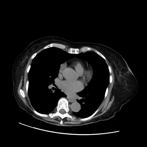 Closed loop small bowel obstruction due to adhesive band, with intramural hemorrhage and ischemia (Radiopaedia 83831-99017 Axial non-contrast 4).jpg
