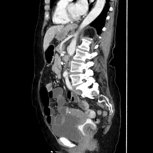Closed loop small bowel obstruction due to adhesive band, with intramural hemorrhage and ischemia (Radiopaedia 83831-99017 D 113).jpg