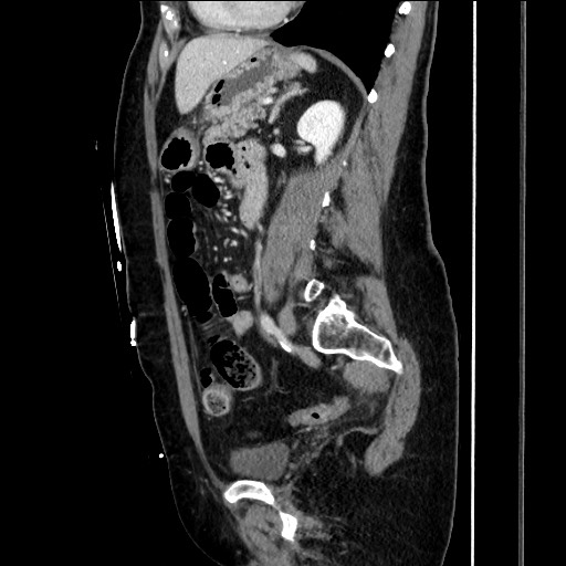 Closed loop small bowel obstruction due to adhesive bands - early and late images (Radiopaedia 83830-99014 C 112).jpg