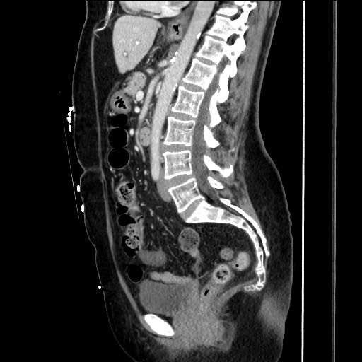 Closed loop small bowel obstruction due to adhesive bands - early and late images (Radiopaedia 83830-99014 C 96).jpg