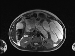 File:Closed loop small bowel obstruction in pregnancy (MRI) (Radiopaedia 87637-104031 Axial T2 24).jpg