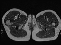 Closed loop small bowel obstruction in pregnancy (MRI) (Radiopaedia 87637-104031 D 49).jpg