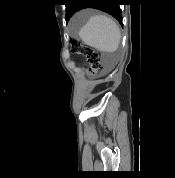 File:Closed loop small bowel obstruction with ischemia (Radiopaedia 84180-99456 C 13).jpg
