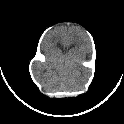 File:Cloverleaf shaped skull in the absence of craniosynostosis (Radiopaedia 21296-21216 Axial non-contrast 7).jpg