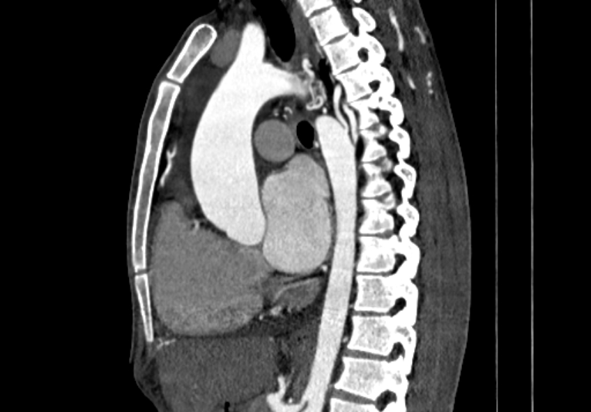 Coarctation of aorta with aortic valve stenosis (Radiopaedia 70463-80574 B 66).jpg