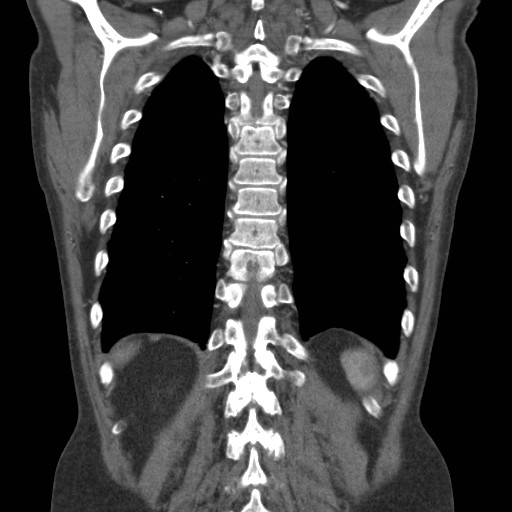 File:Coarctation of the aorta (Radiopaedia 17427-17116 A 21).jpg
