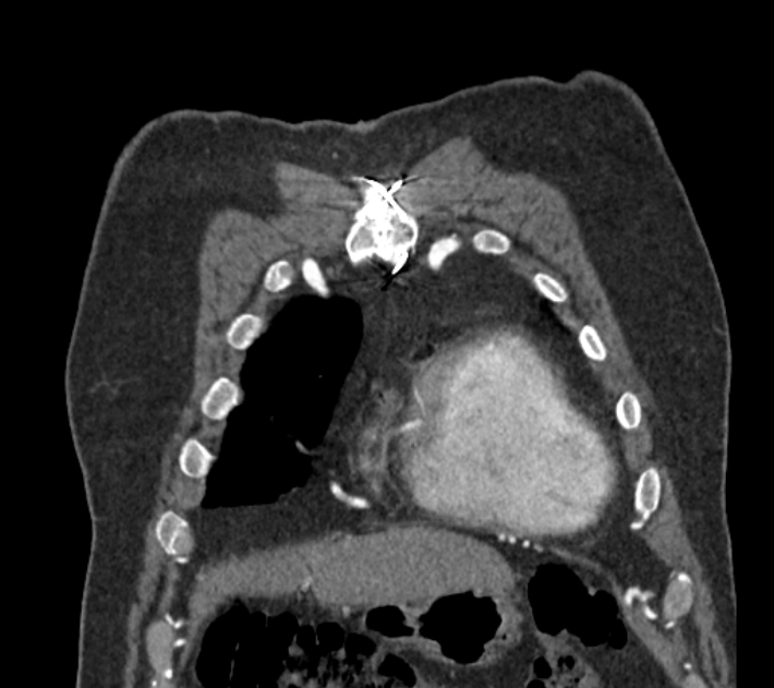 Coarctation of the aorta (Radiopaedia 53752-59822 B 15).jpg