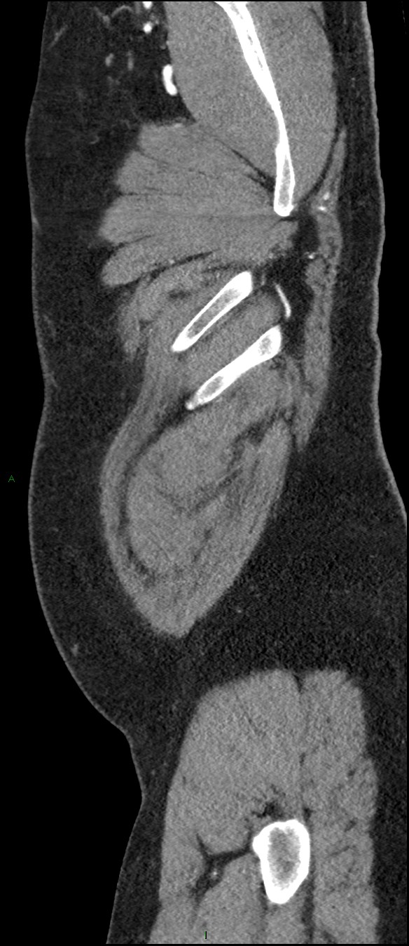 Coarctation of the aorta (Radiopaedia 74632-88521 C 9).jpg