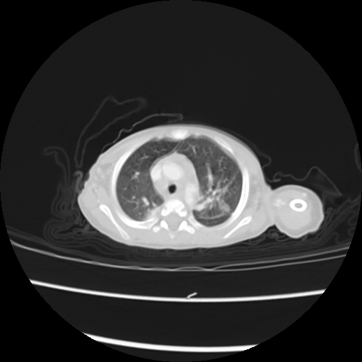 Coarctation of the aorta and patent ductus arteriosus (Radiopaedia 68033-77499 Axial lung window 12).jpg