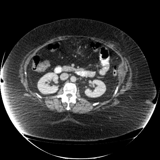 File:Collection due to leak after sleeve gastrectomy (Radiopaedia 55504-61972 A 37).jpg