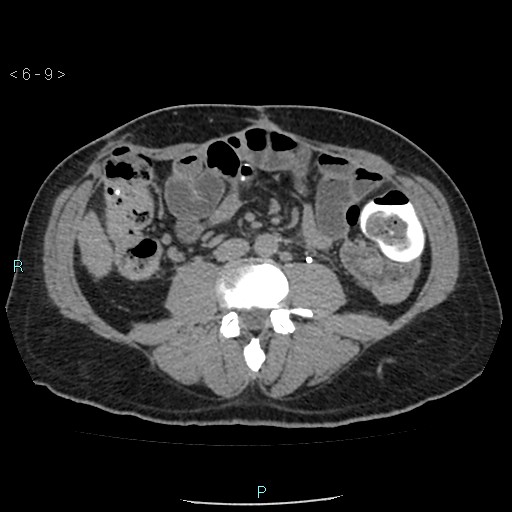 File:Colo-cutaneous fistula (Radiopaedia 40531-43129 A 3).jpg