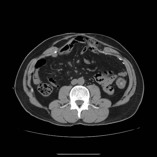 File:Colocutaneous fistula in Crohn's disease (Radiopaedia 29586-30093 D 5).jpg