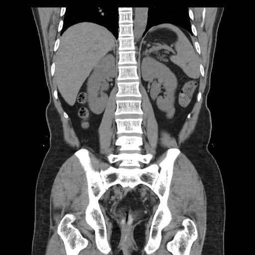 File:Colocutaneous fistula in Crohn's disease (Radiopaedia 29586-30093 E 31).jpg