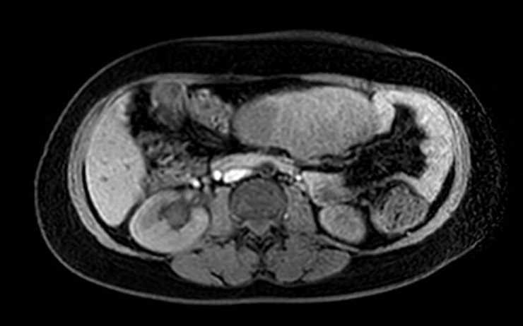 Colon adenocarcinoma with Krukenberg tumors, advanced pregnancy (Radiopaedia 67279-76645 A 48).jpg