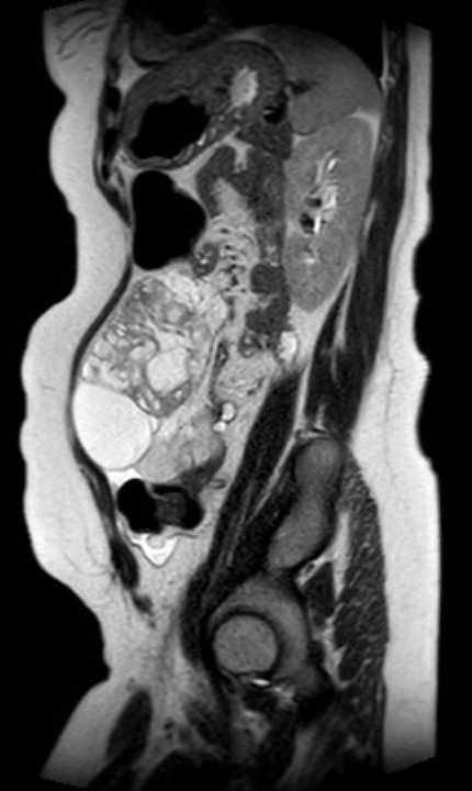 Colon adenocarcinoma with Krukenberg tumors, advanced pregnancy (Radiopaedia 67279-76645 Sagittal T2 17).jpg