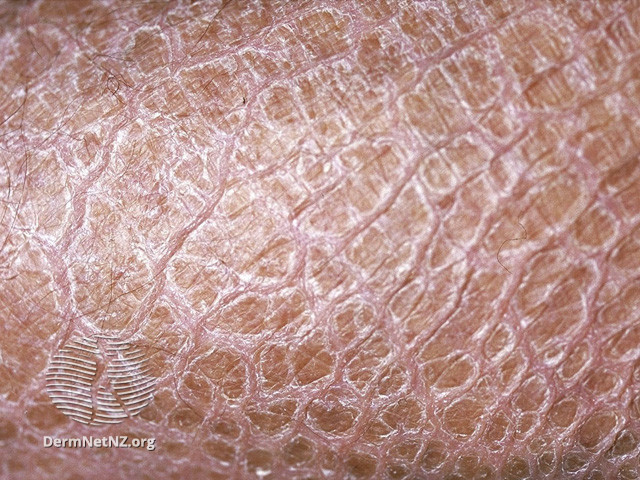 File:Kava ichthyosis (DermNet NZ scaly-s-ichthyosis3).jpg