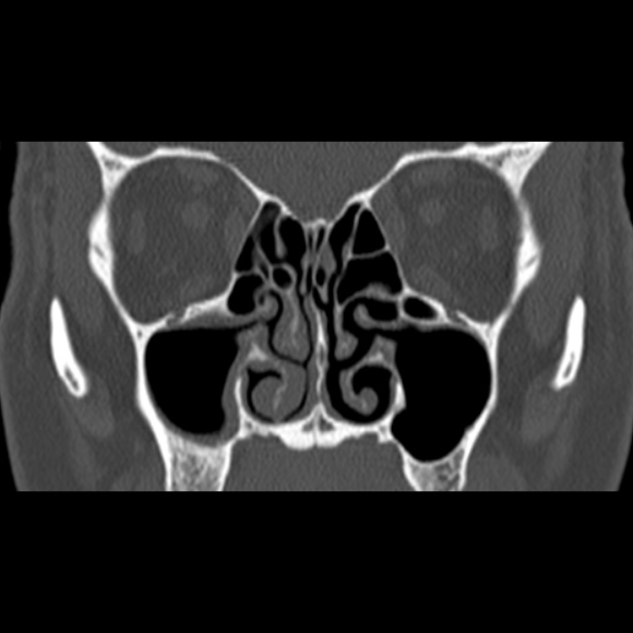 File:Nasal septal perforation (Radiopaedia 25030-25289 Coronal bone window 35).jpg
