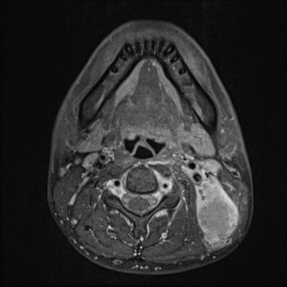 Nasopharyngeal carcinoma with skull base invasion (Radiopaedia 53415-59485 Axial T1 C+ fat sat 46).jpg