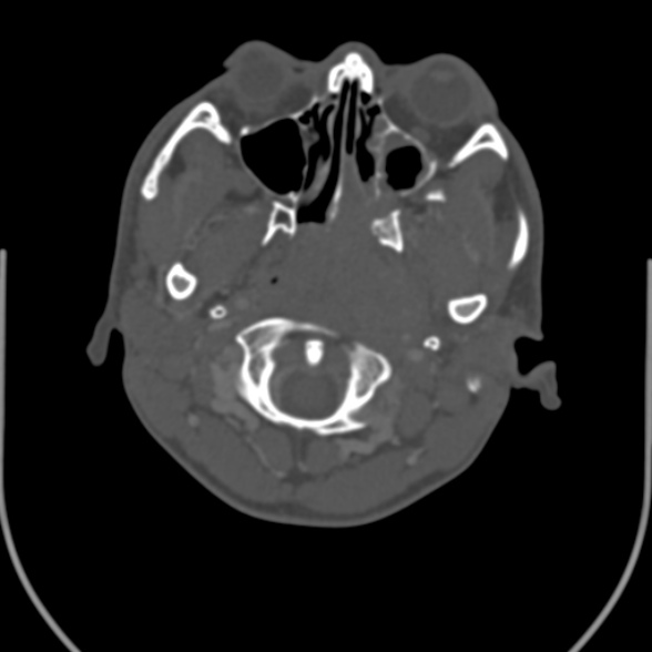 Nasopharyngeal carcinoma with skull base invasion (Radiopaedia 53415-59705 Axial bone window 39).jpg