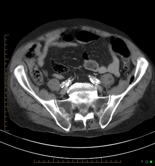 Necrotzing fasciitis due to a perforated adenocarcinoma of the splenic flexure (Radiopaedia 46930-51455 A 47).jpg