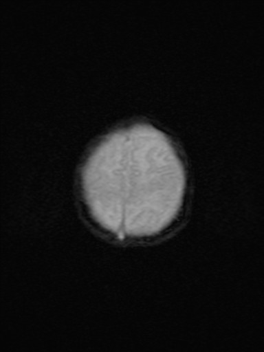 File:Neonatal hypoxic-ischemic encephalopathy (Radiopaedia 41406-44277 Axial Gradient Echo 3).jpg