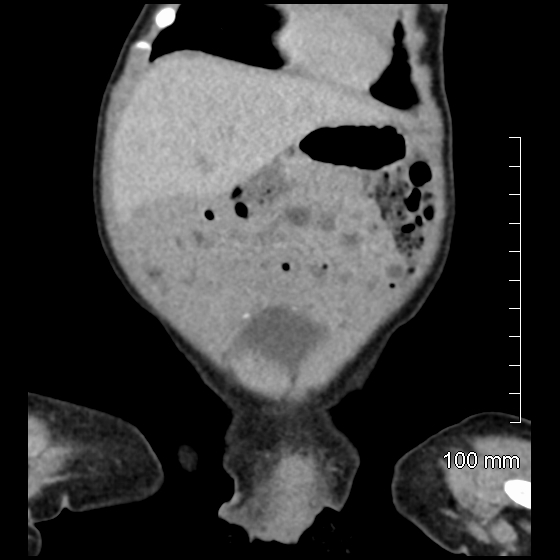 File:Neonatal neuroblastoma (Radiopaedia 56651-63438 Coronal non-contrast 13).jpg