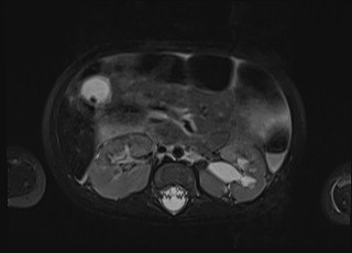 Neonatal prostatic utricle abscess - cyst (Radiopaedia 69511-79394 Axial T2 fat sat 50).jpg