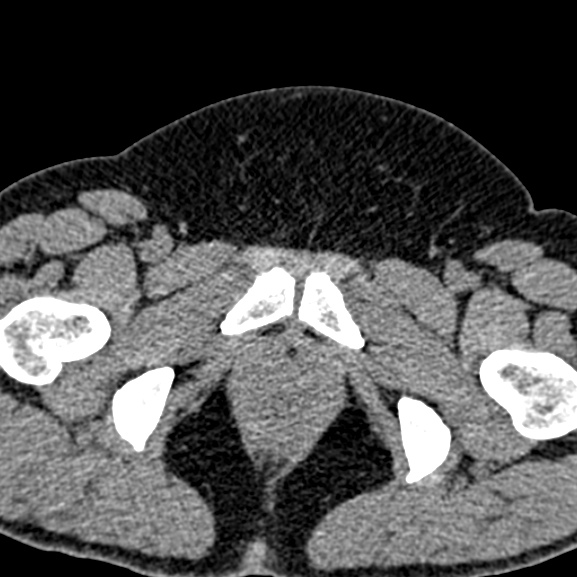 File:Nephrostomy for pyonephrosis (Radiopaedia 21498-21439 Axial non-contrast 23).jpg