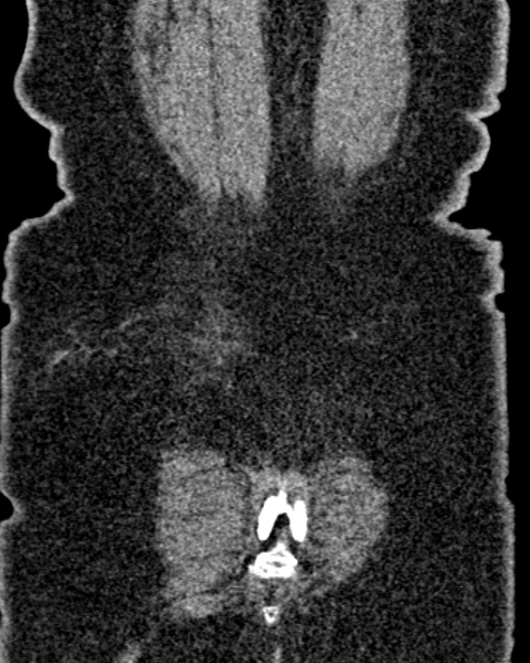 File:Nephrostomy for urosepsis (Radiopaedia 26180-26330 non-contrast 83).jpg