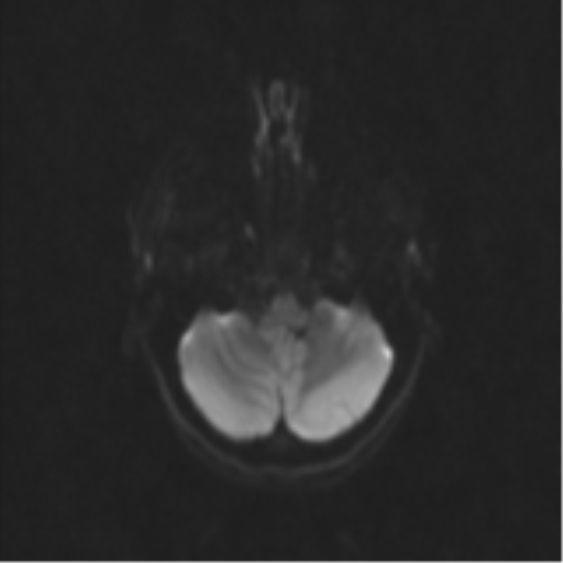 Neurenteric cyst (Radiopaedia 58641-65837 Axial DWI 42).png