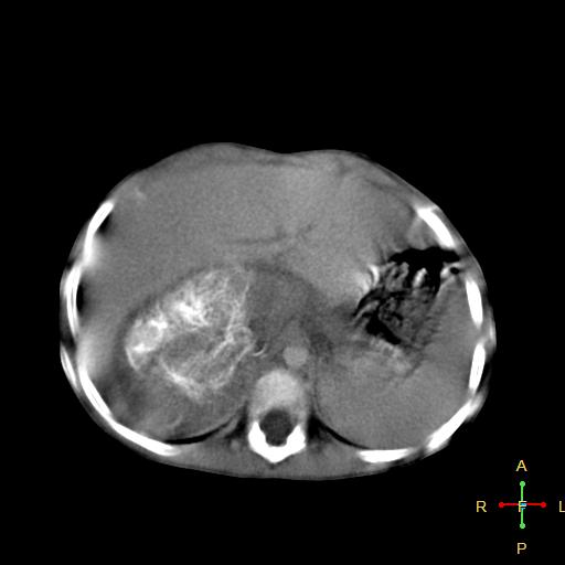 File:Neuroblastoma (Radiopaedia 24751-25016 D 8).jpg