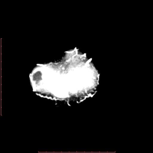 File:Neuroblastoma skull metastasis (Radiopaedia 56053-62683 Axial +Contrast 17).jpg