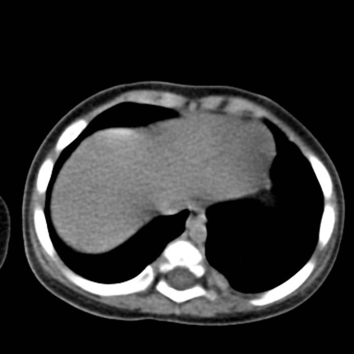 Neuroblastoma with skull metastases (Radiopaedia 30326-30960 Axial non-contrast 3).jpg