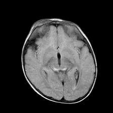 File:Neurofibromatosis type 1 (Radiopaedia 30089-30671 Axial FLAIR 11).jpg
