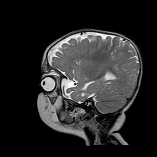 File:Neurofibromatosis type 1 (Radiopaedia 30089-30671 Sagittal T2 15).jpg