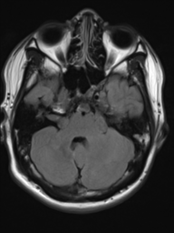 File:Neurofibromatosis type 2 (Radiopaedia 44936-48838 Axial FLAIR 6).png