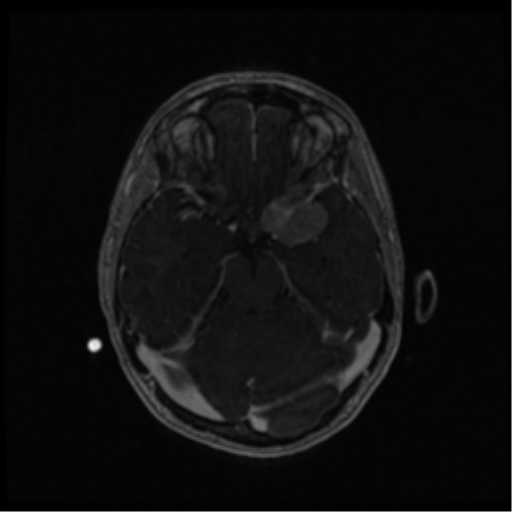 Neurofibromatosis type 2 (Radiopaedia 45229-49244 Axial T1 C+ 50).png