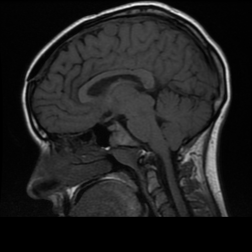 File:Neurofibromatosis type 2 (Radiopaedia 45229-49244 Sagittal T1 11).png