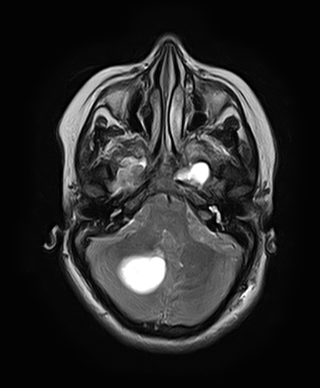 File:Neurofibromatosis type 2 (Radiopaedia 66211-75401 Axial T2 10).jpg