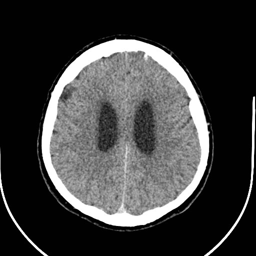 Neurofibromatosis type 2 (Radiopaedia 79097-92047 Axial non-contrast 42).jpg