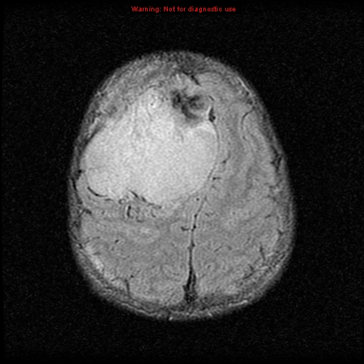 File:Neurofibromatosis type 2 (Radiopaedia 8953-9730 Axial FLAIR 21).jpg