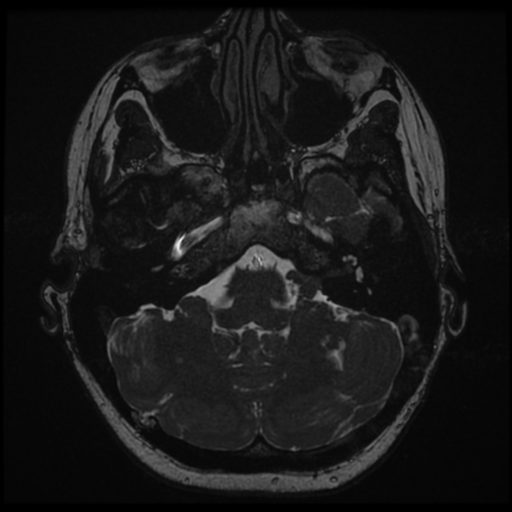 Neurofibromatosis type 2 - bilateral acoustic neuromata (Radiopaedia 40060-42566 Axial FIESTA 28).png