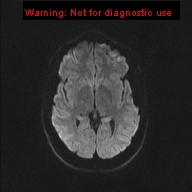 File:Neuroglial cyst (Radiopaedia 10713-11184 Axial DWI 35).jpg