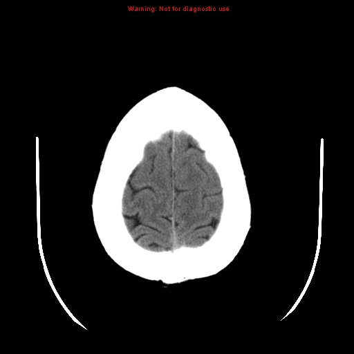 File:Neuroglial cyst (Radiopaedia 10713-11185 Axial non-contrast 5).jpg